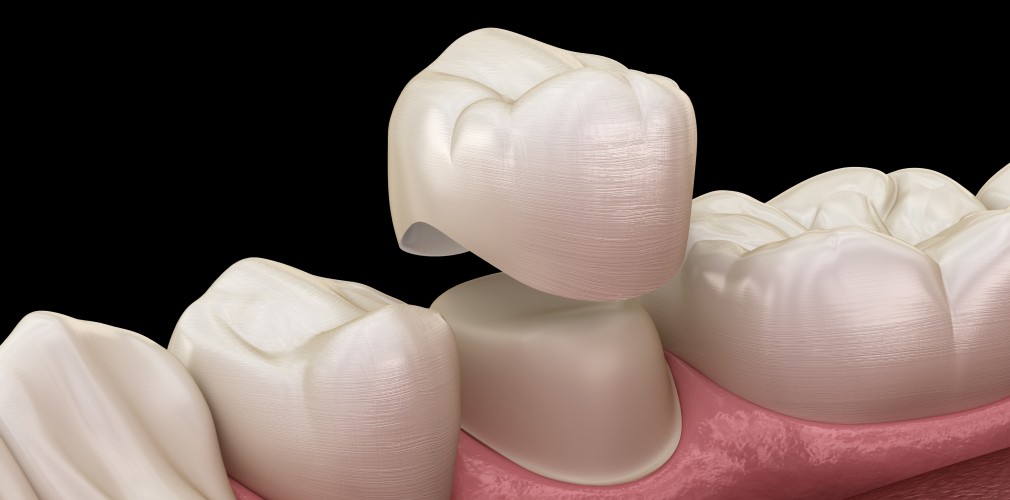 Pourquoi une couronne dentaire  Cabinet Dentaire Castellane 13006.