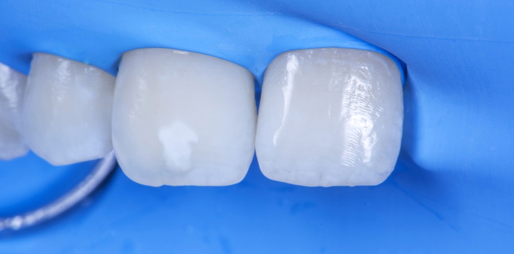 La digue dentaire : quand le confort rencontre la sécurité